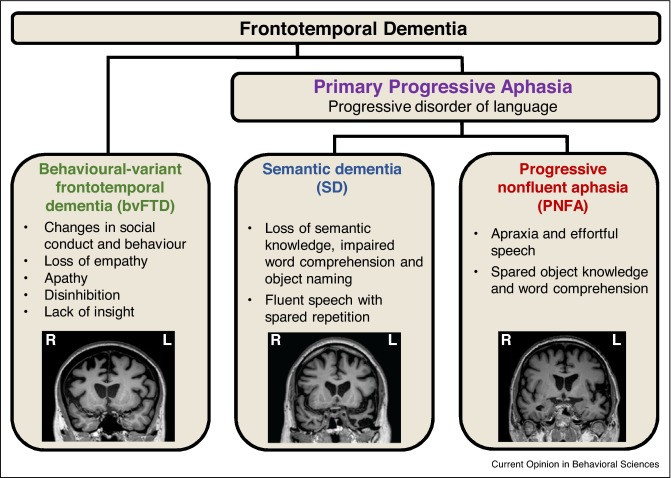 Frontotemporal Dementia...What Is It?