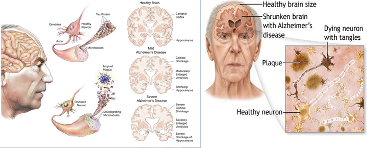 Frontotemporal dementia