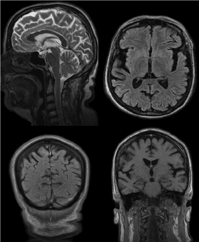 Head MRI of the proband demon