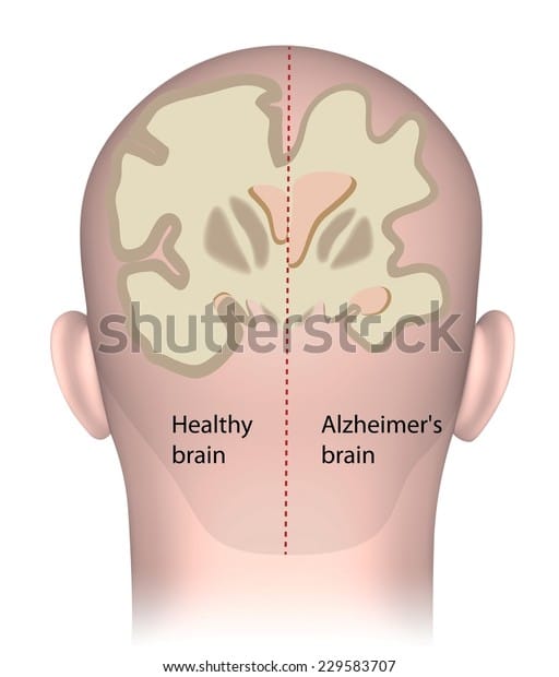 Healthy Brain Vs Alzheimers Brain Stock Illustration 229583707
