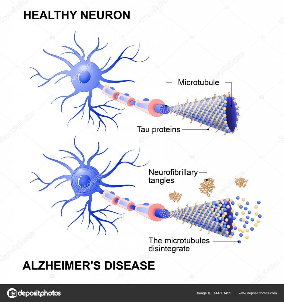 Healthy cell and neurons with Alzheimer