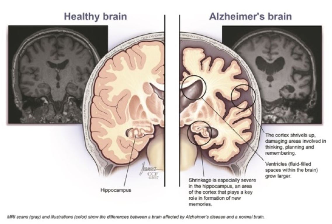 HOW ALZHEIMERS AFFECTS THE BRAIN