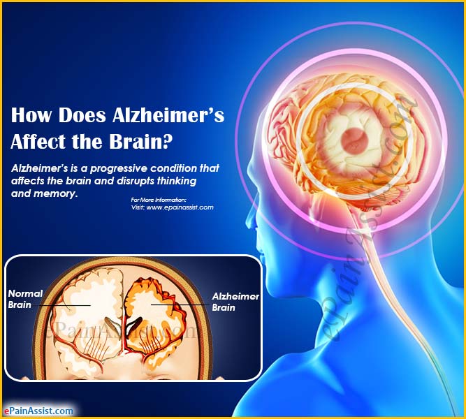 How Does Alzheimer