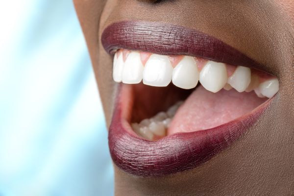 How Often Should You Have a Professional Teeth Whitening ...