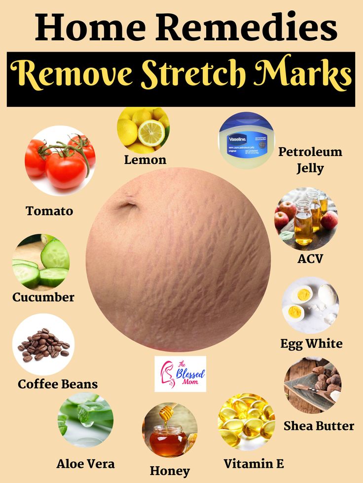 How To Get Rid Of Stretch Marks Naturally ( Causes+ Home ...