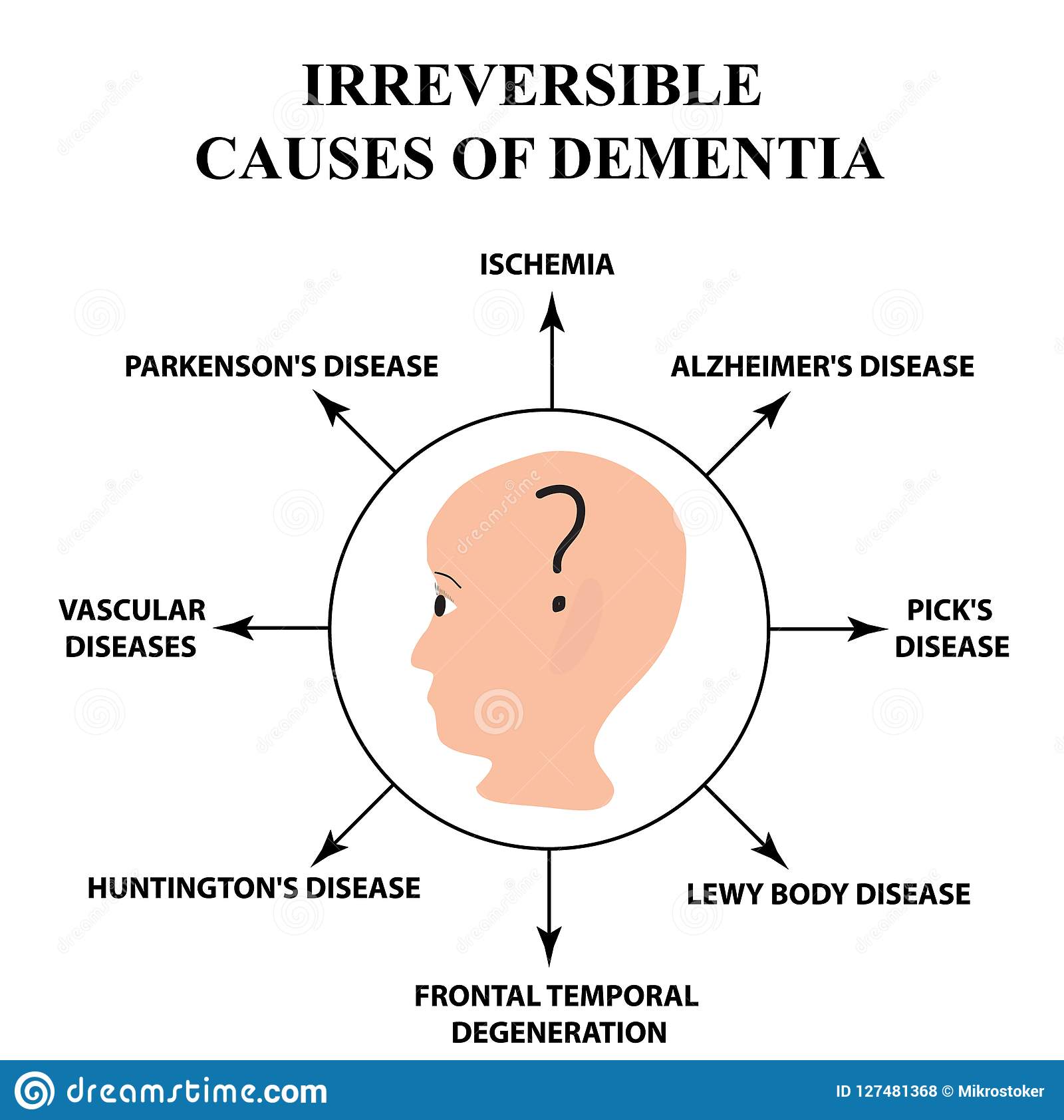 Irreversible Causes of Senile Dementia. Alzheimer`s Disease ...