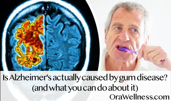 Is Alzheimerâs actually caused by gum disease? (and what ...