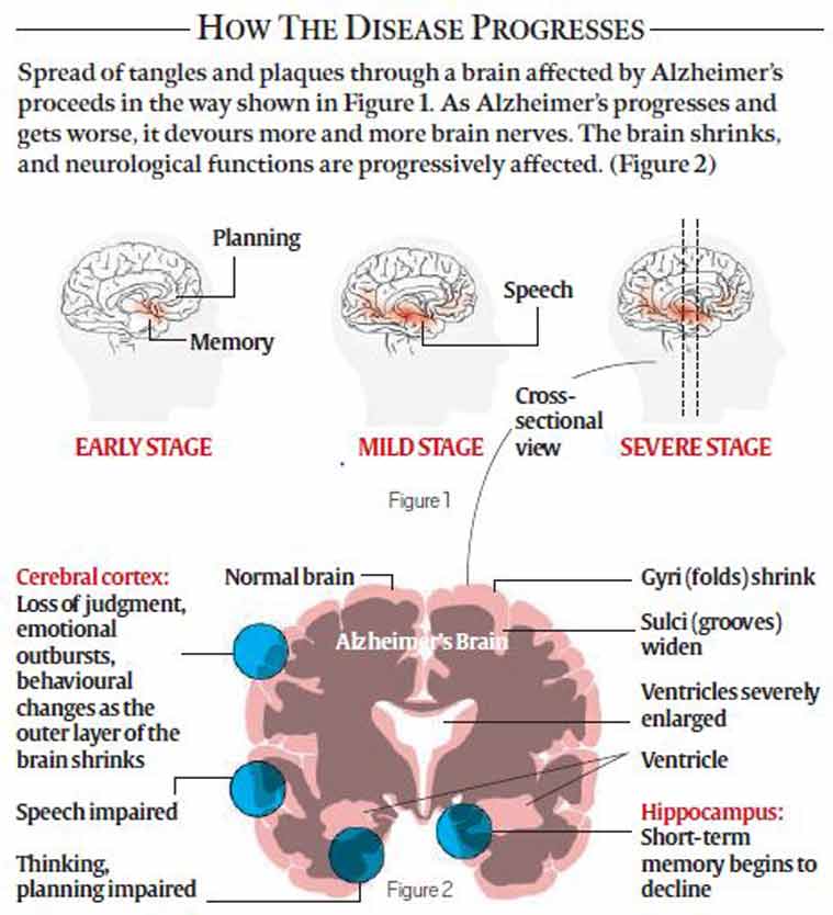 Latest research on fighting alzheimers disease: More Trials And Some ...
