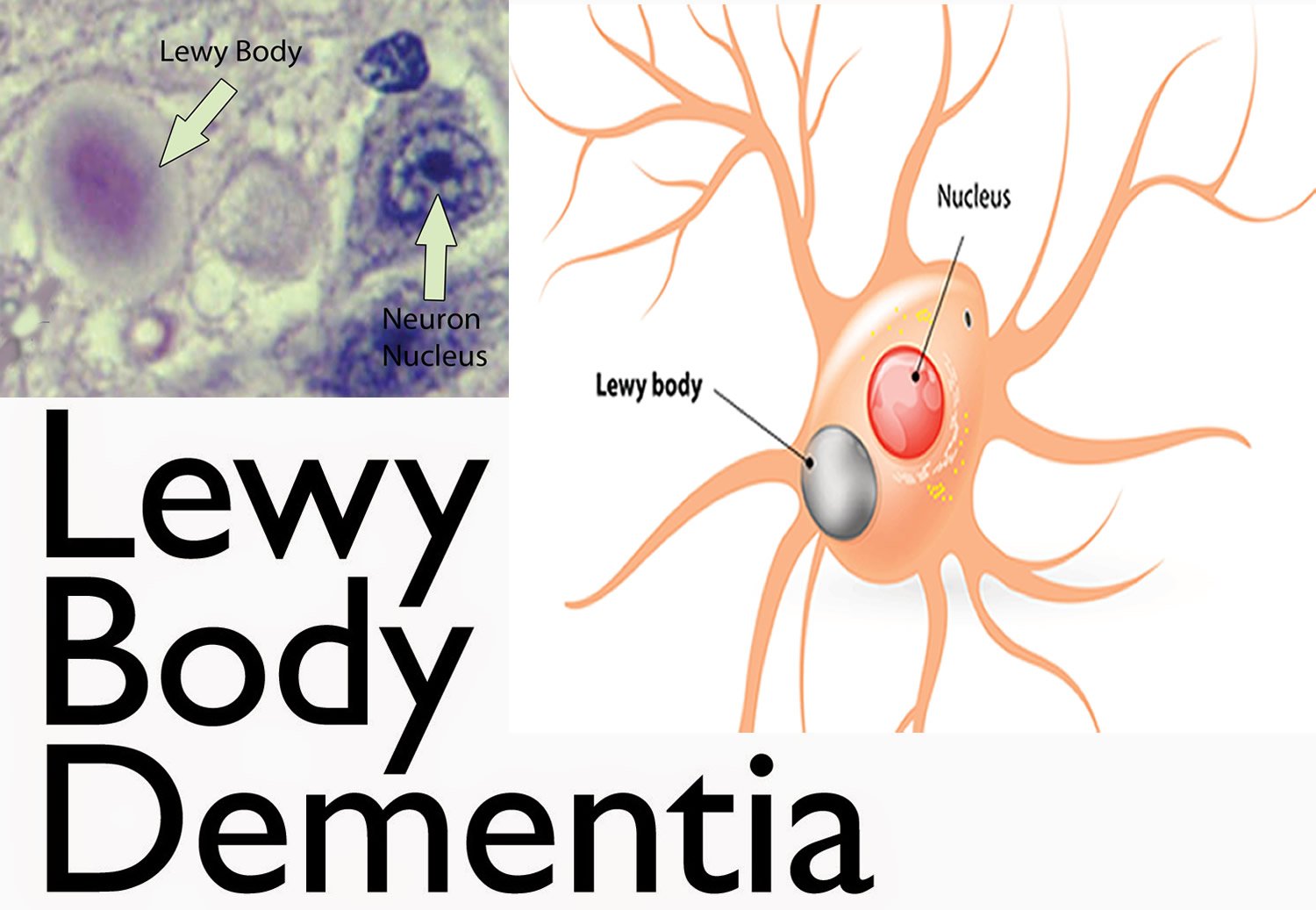Lewy Body Dementia  Third Most Common Form of Dementia