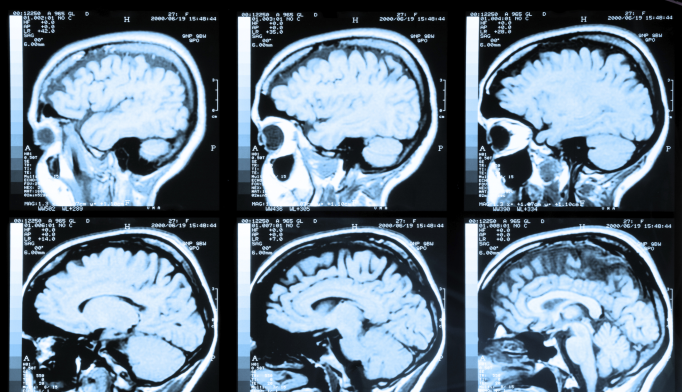 MRI Can Detect Early Stages of Alzheimer