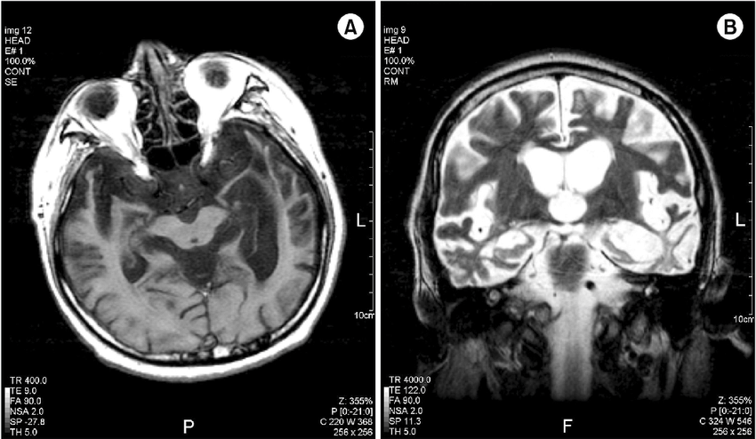 MRI findings in frontotemporal dementia (FTD). T1 (A) and ...