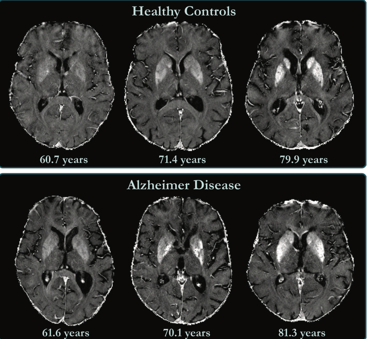 MRI Shows Link Between Higher Brain Iron Levels and ...