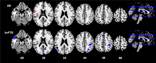Neural networks associated with body composition in frontotemporal ...