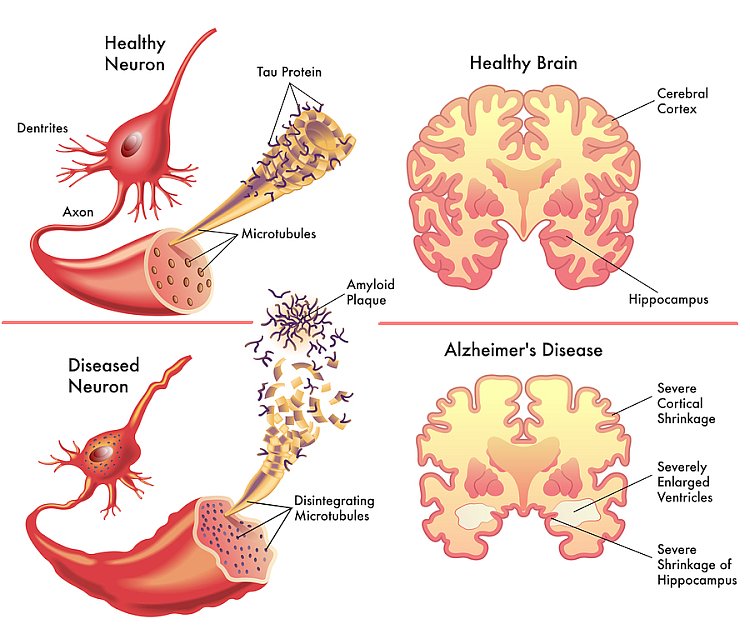 New blood test can help detect Alzheimers disease in presymptomatic ...