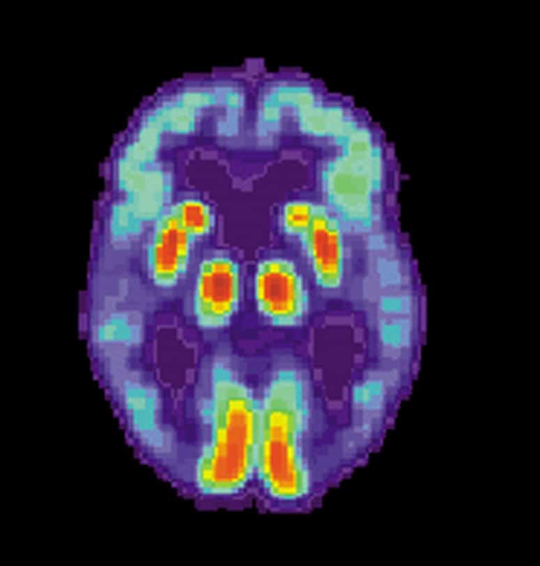 New cell model of most common form of Alzheimer