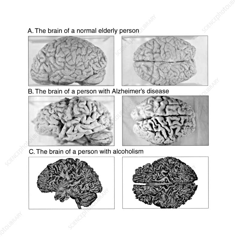 Normal, Alzheimer and Alcoholic Brains