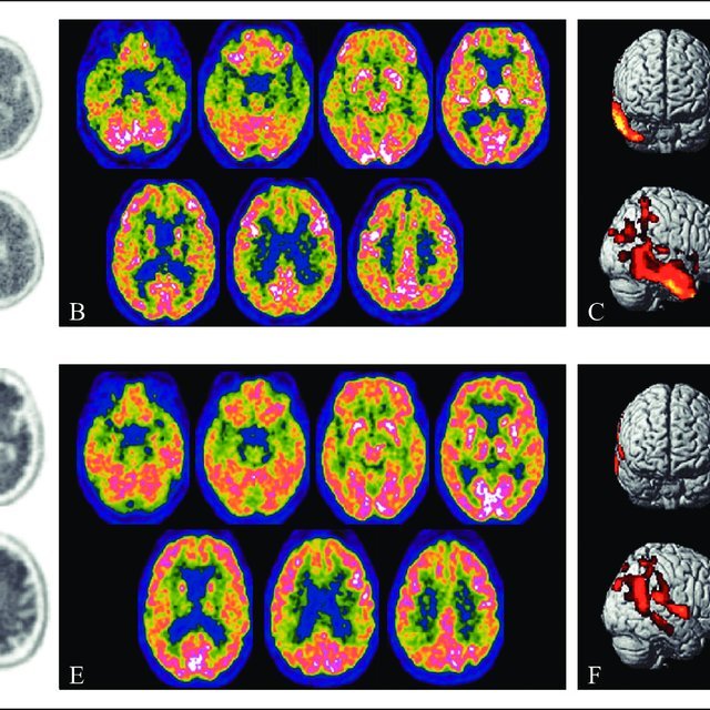 (PDF) Imaging biomarkers in Alzheimer