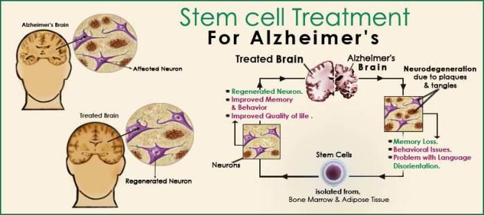 Plan the Stem Cell Therapy for Alzheimer
