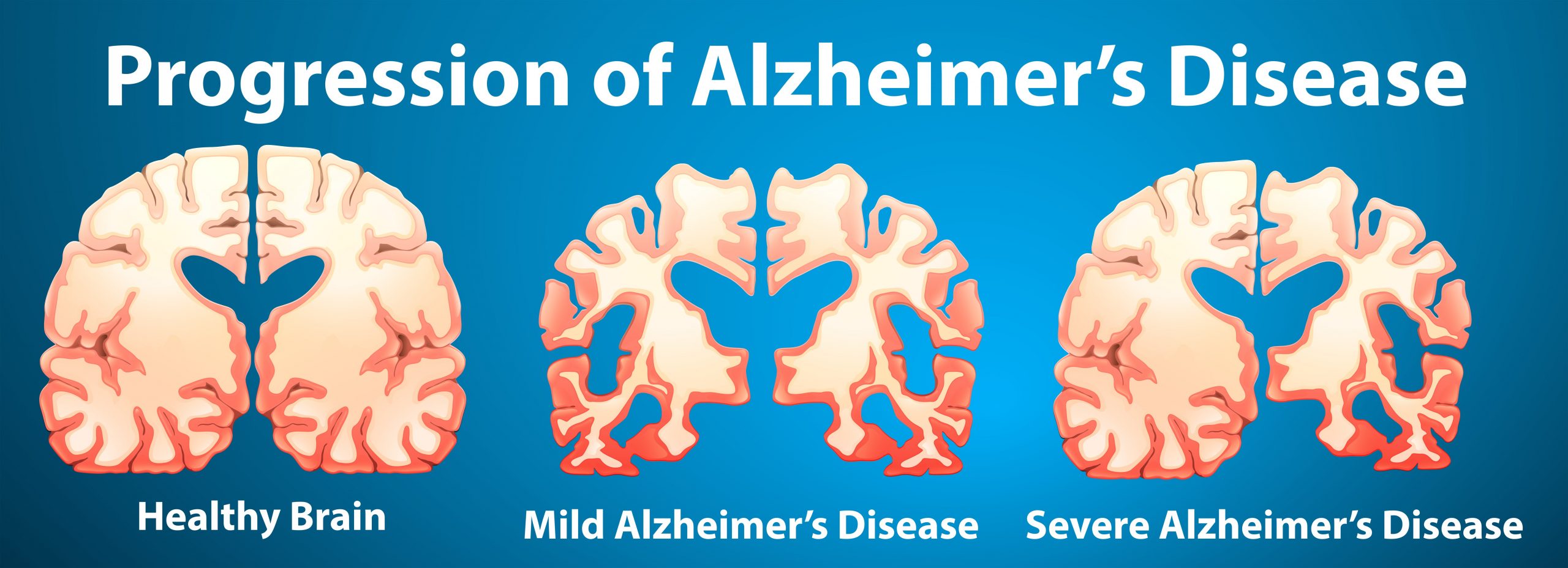 Progression of Alzheimer