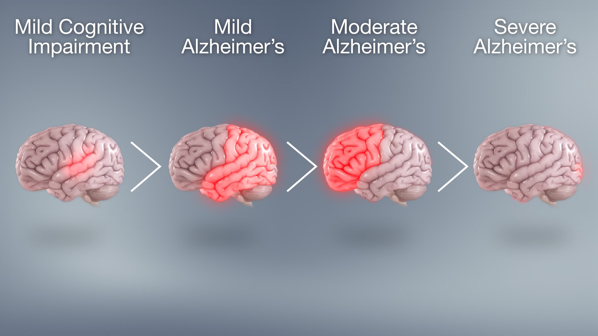 Progression of Alzheimers disease through different stages