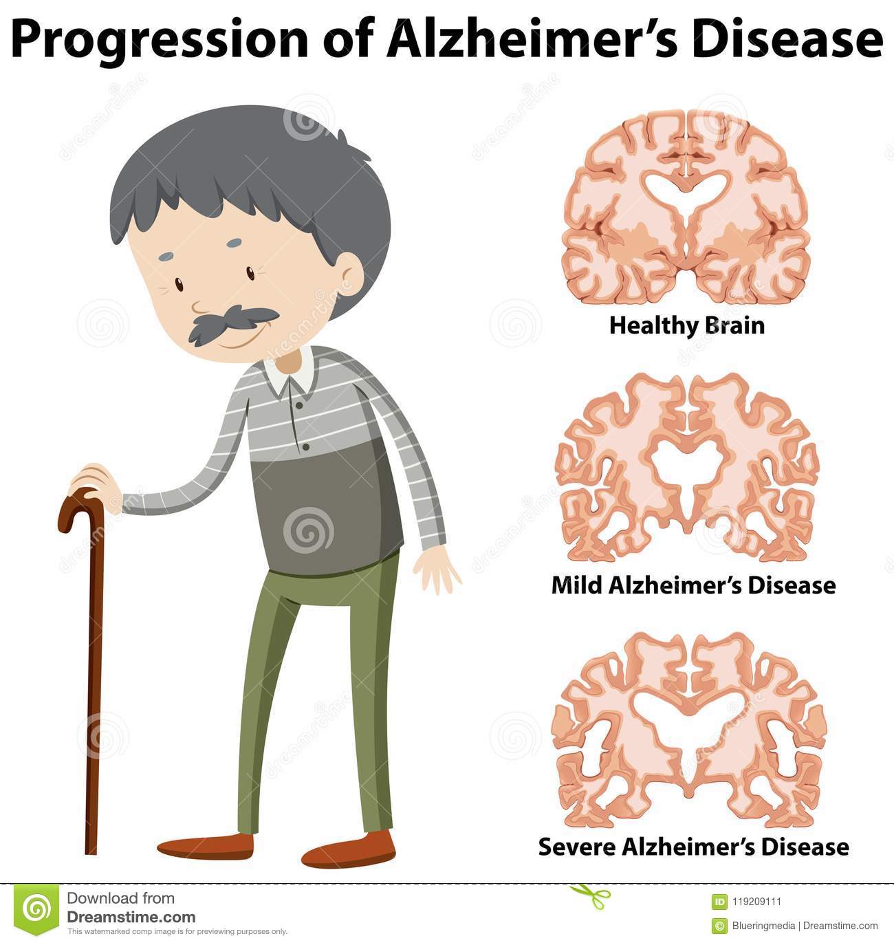 Progressione Della Malattia Del ` S Di Alzheimer Illustrazione ...