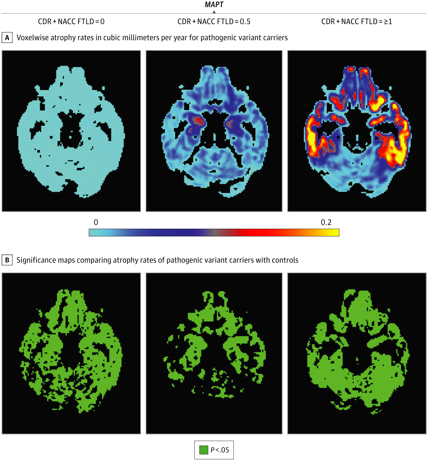 Rates of Brain Atrophy Across Disease Stages in Familial Frontotemporal ...