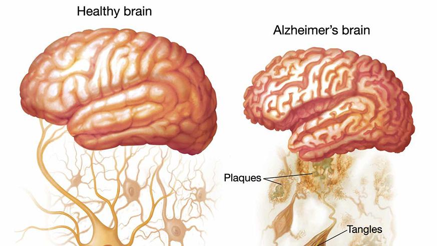 Scientists develop brain scan to detect Alzheimers ...