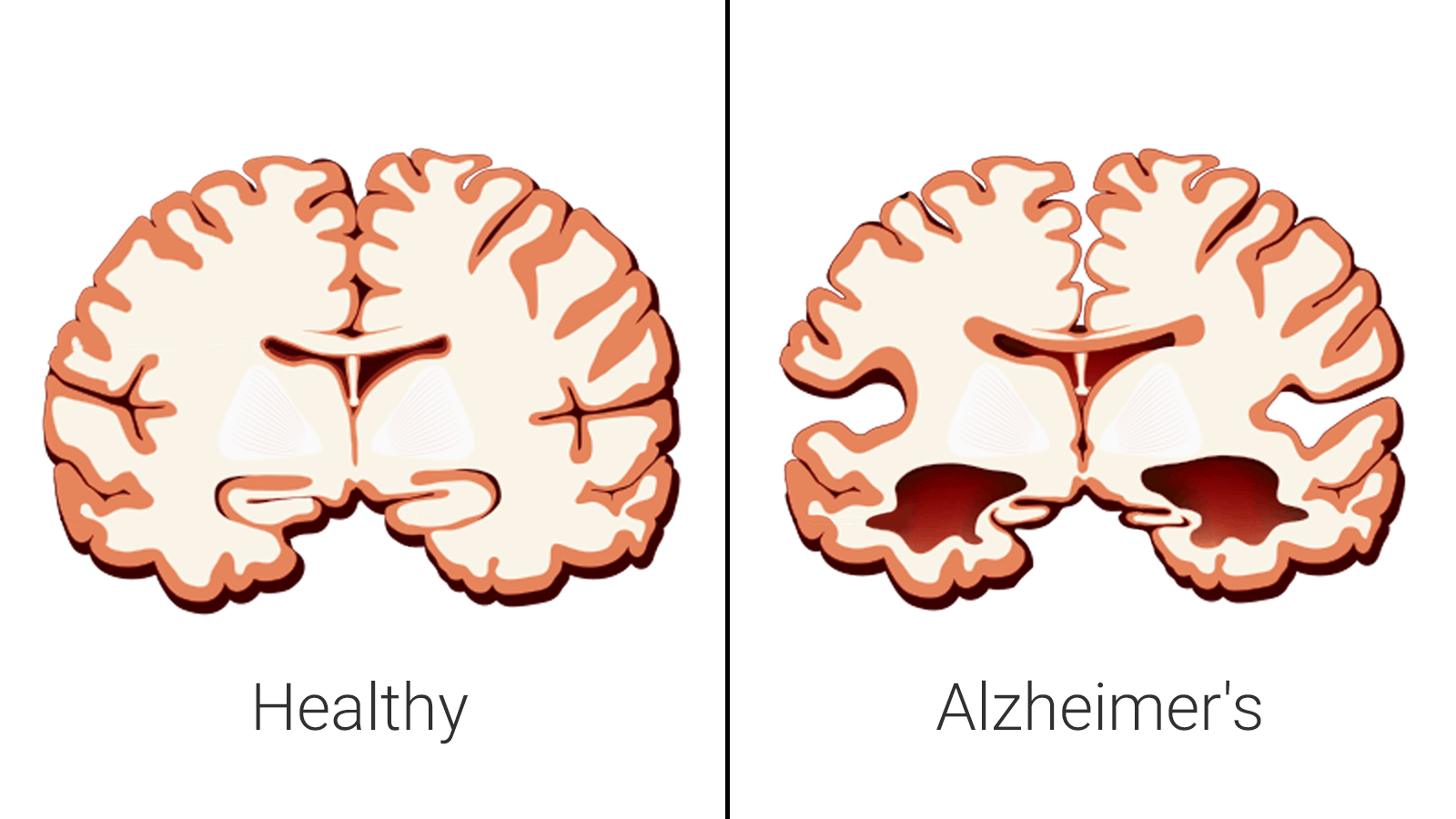 Scientists Explain How Anxiety Can Cause Alzheimer