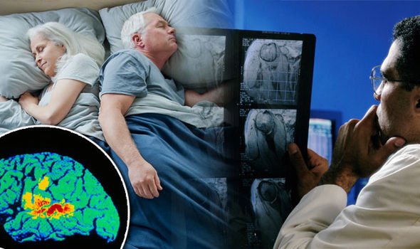 Sleep and Alzheimers Disease, The Chicken or The Egg ...
