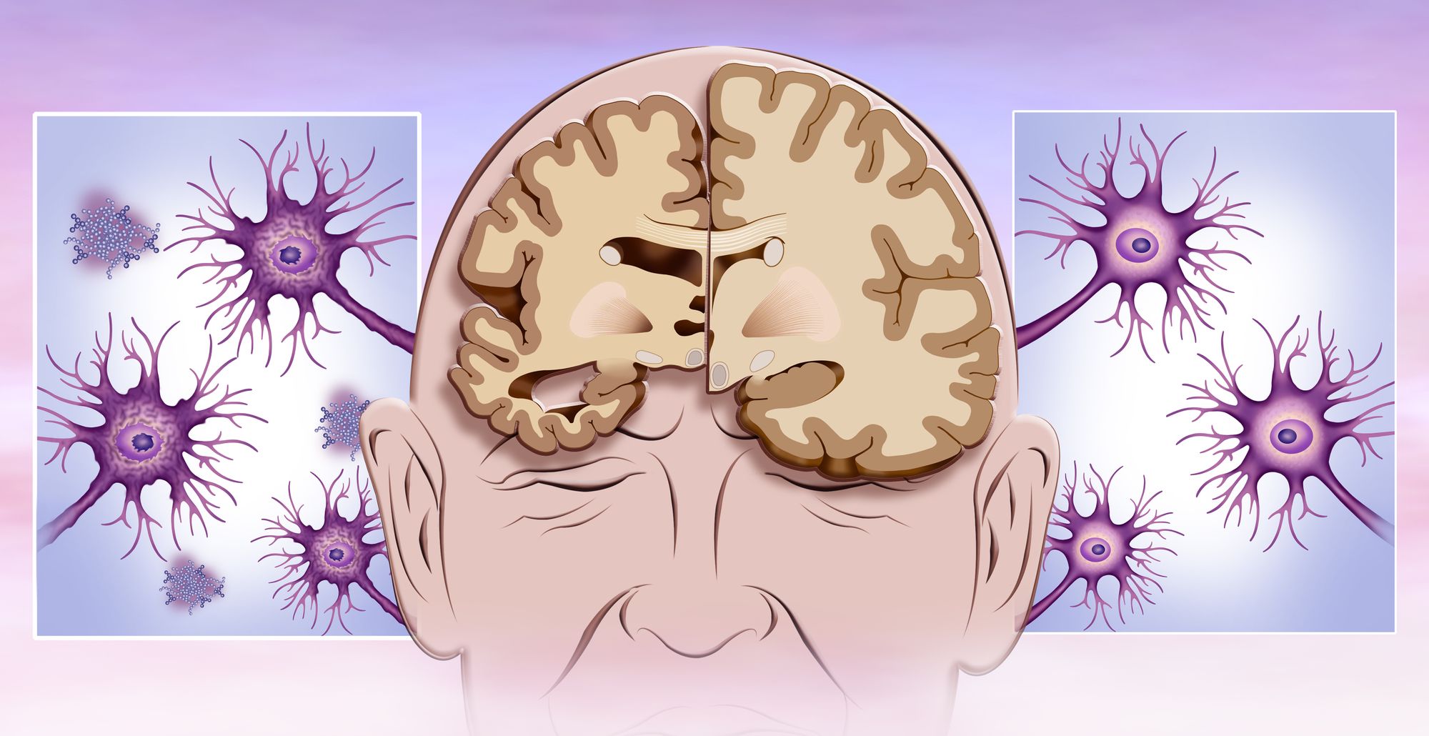 Stroke, Brain Injury, and Dementia: is there a link?