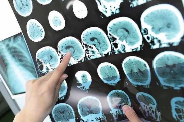 Teenager Develops Test That Can Diagnose Alzheimer