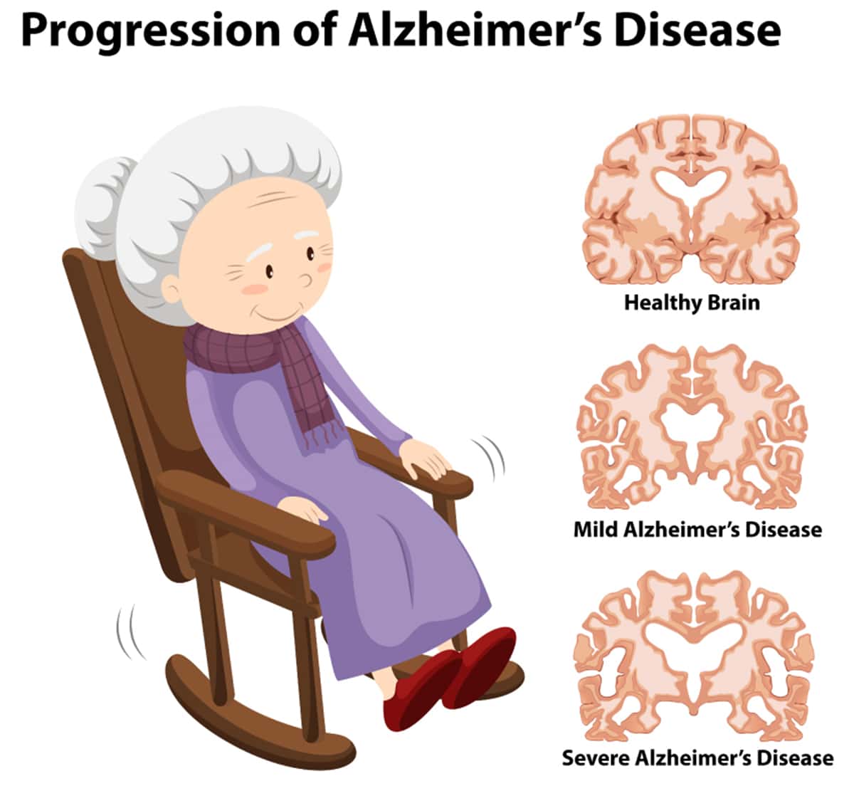The 3 Stages of Alzheimers Disease: How Does the Disease Progress and ...