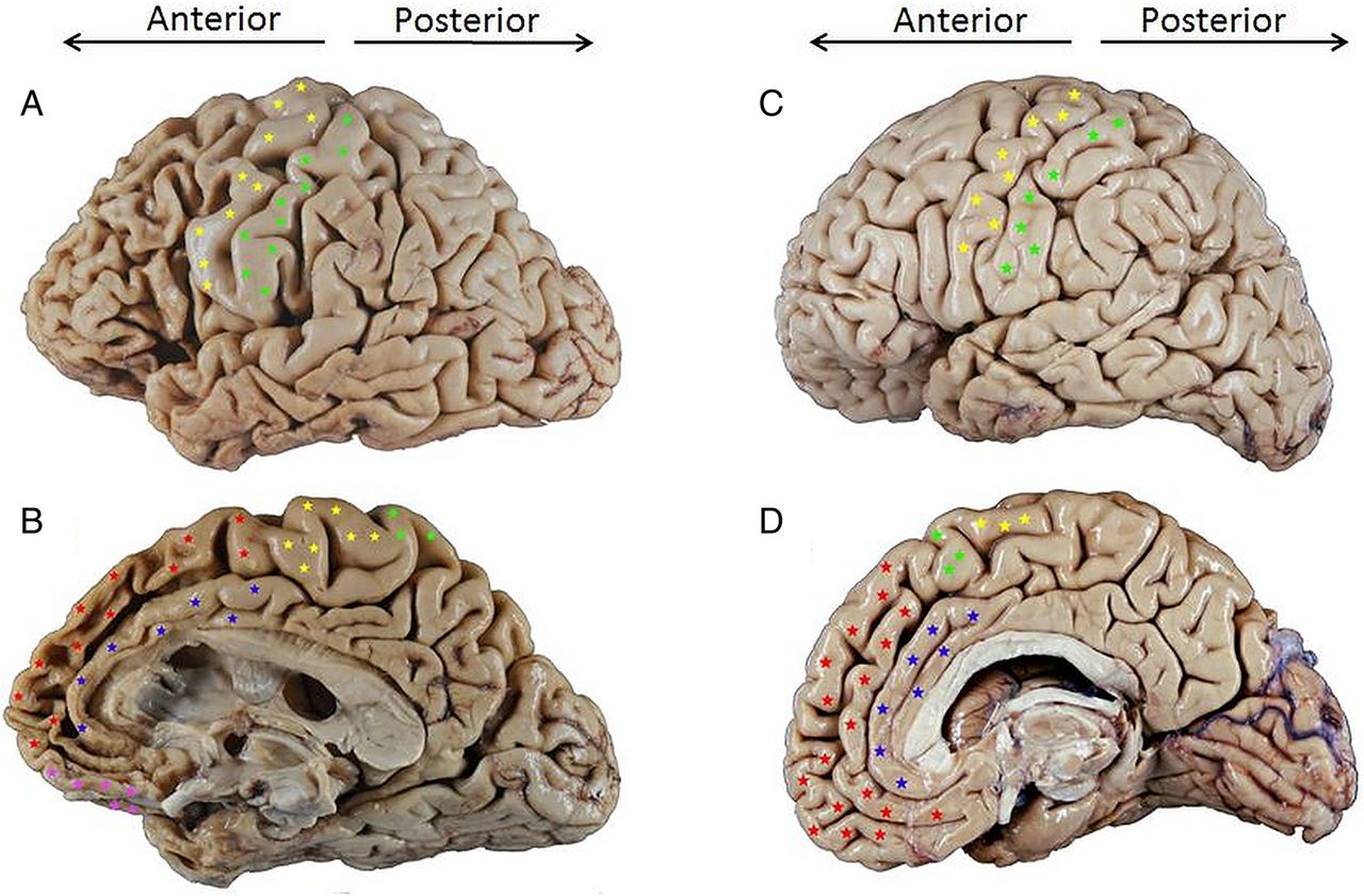 The behavioural variant frontotemporal dementia (bvFTD ...