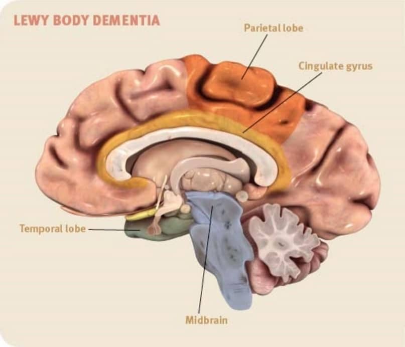 The Neurologist Is In: Lewy Body Dementia Is Often Unknown and Unrecognized