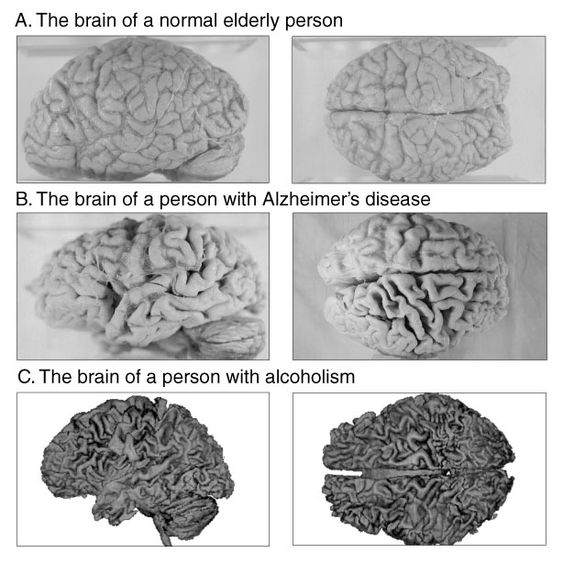 The Pathology of the brain ~ Alcohol Use and the Risk of Developing ...