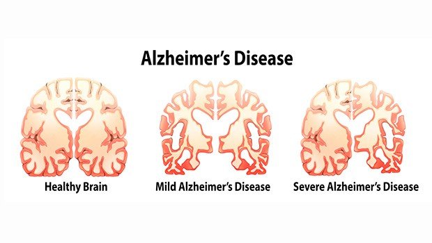 The Real Cause of Alzheimers Disease Revealed