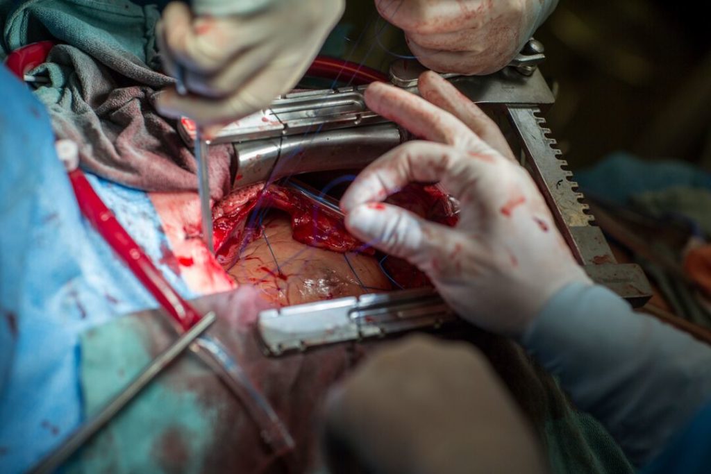Up Close: Open heart surgery