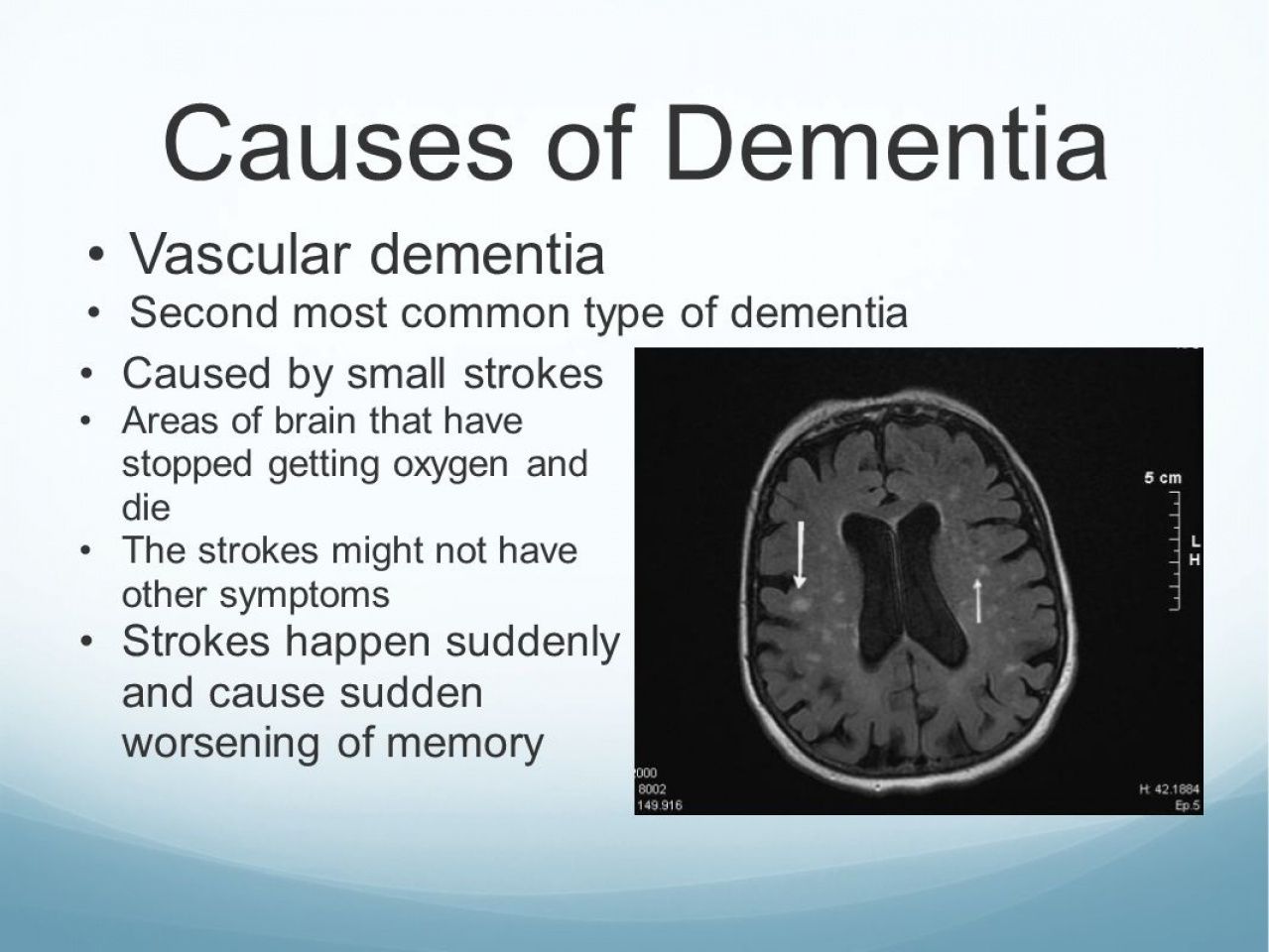 Vascular Dementia Is Caused By