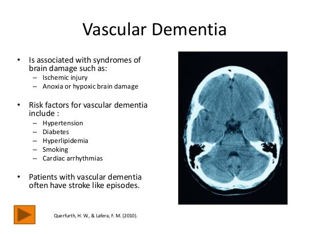 Vascular Dementia: What Is It? Symptoms, Causes, And ...