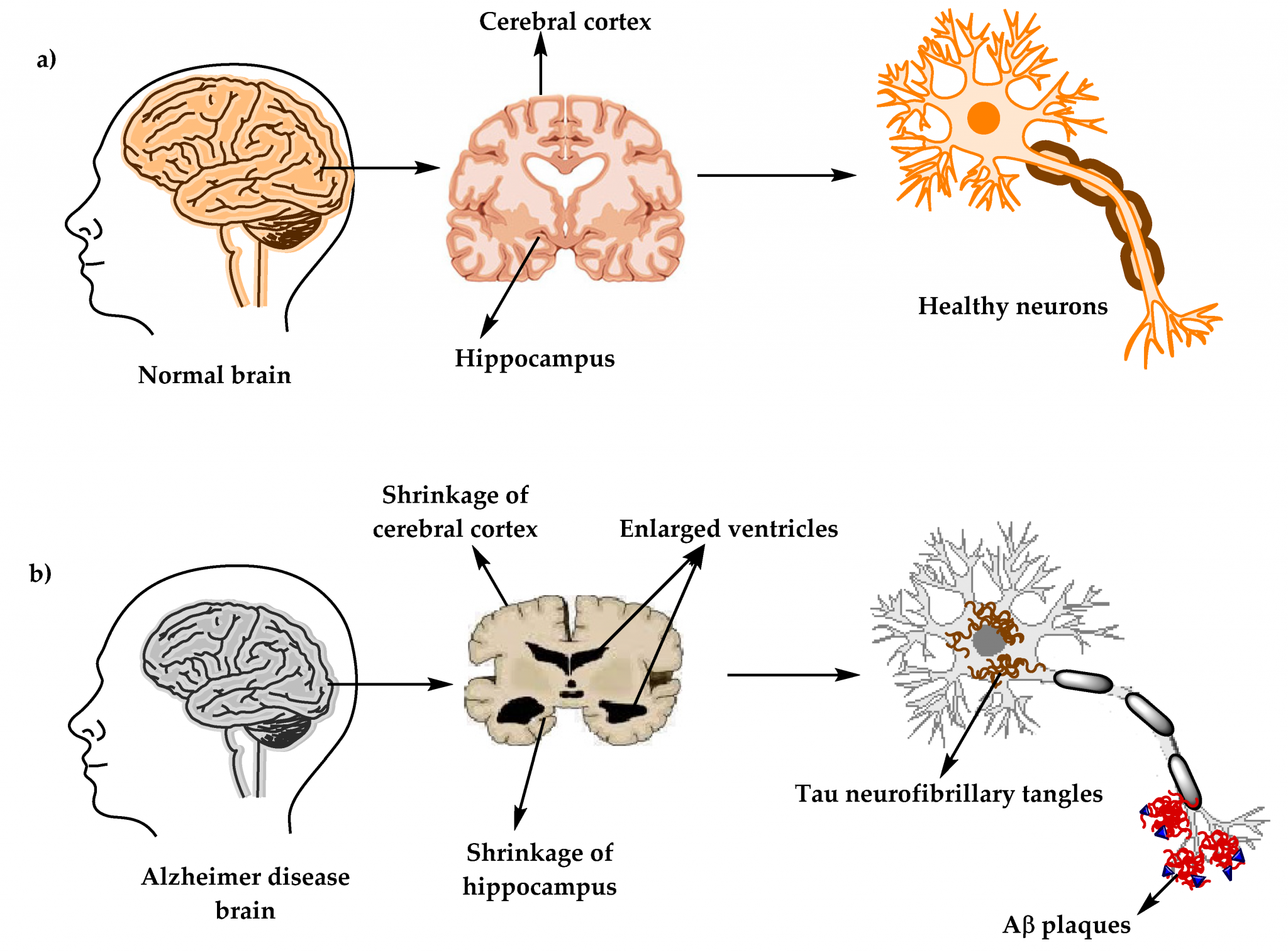 What Are the Symptoms and Stages of Alzheimer