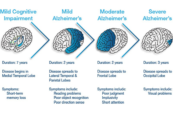 What are the Three Stages of Alzheimer