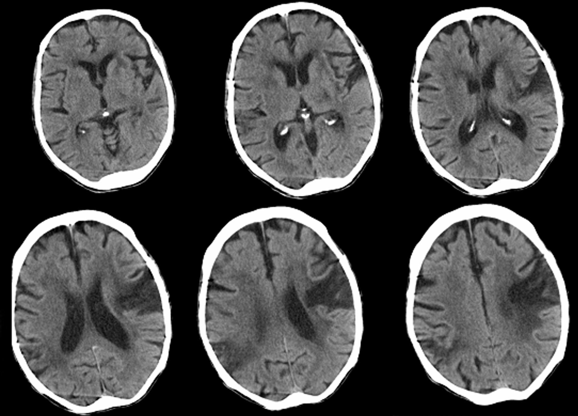 What Does Dementia Look Like On A Ct Scan