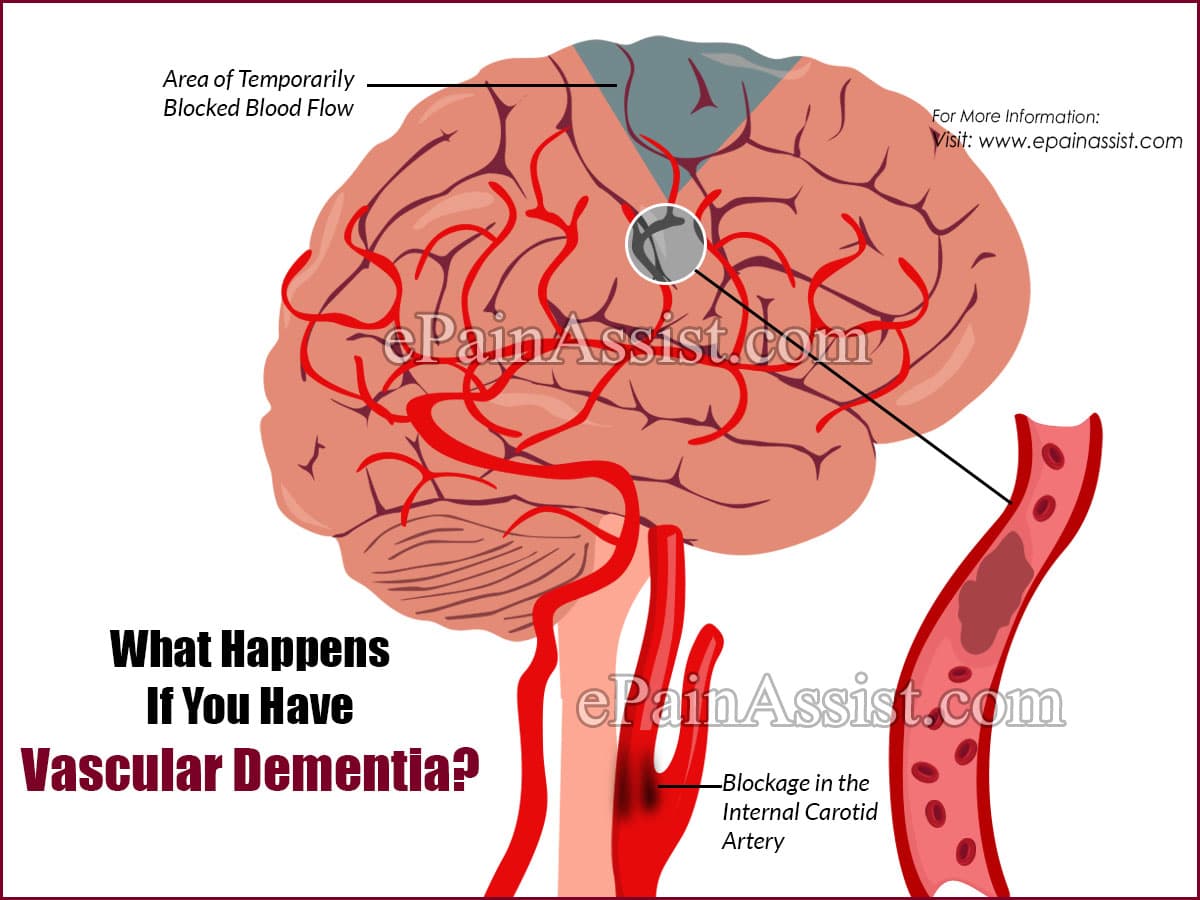 What Happens If You Have Vascular Dementia &  What To Do ...