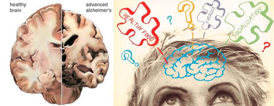 What is Alzheimer