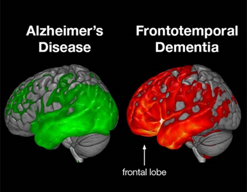 What is Frontotemporal Dementia??