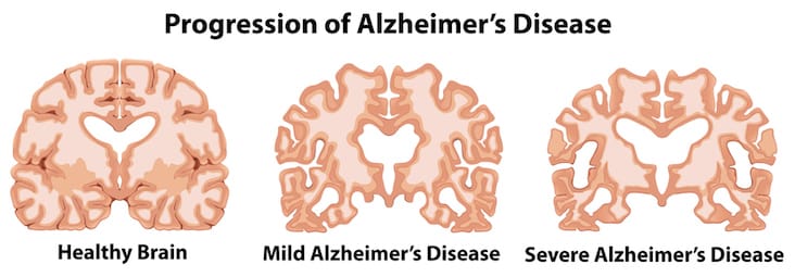 What You Should Know About Alzheimers Disease