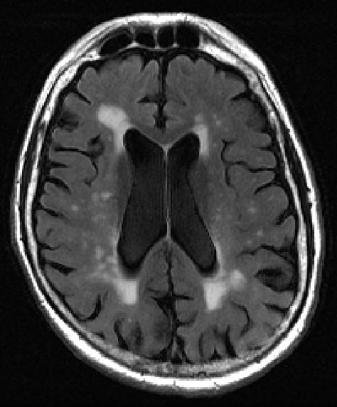 White matter lesion mapping tool identifies early signs ...