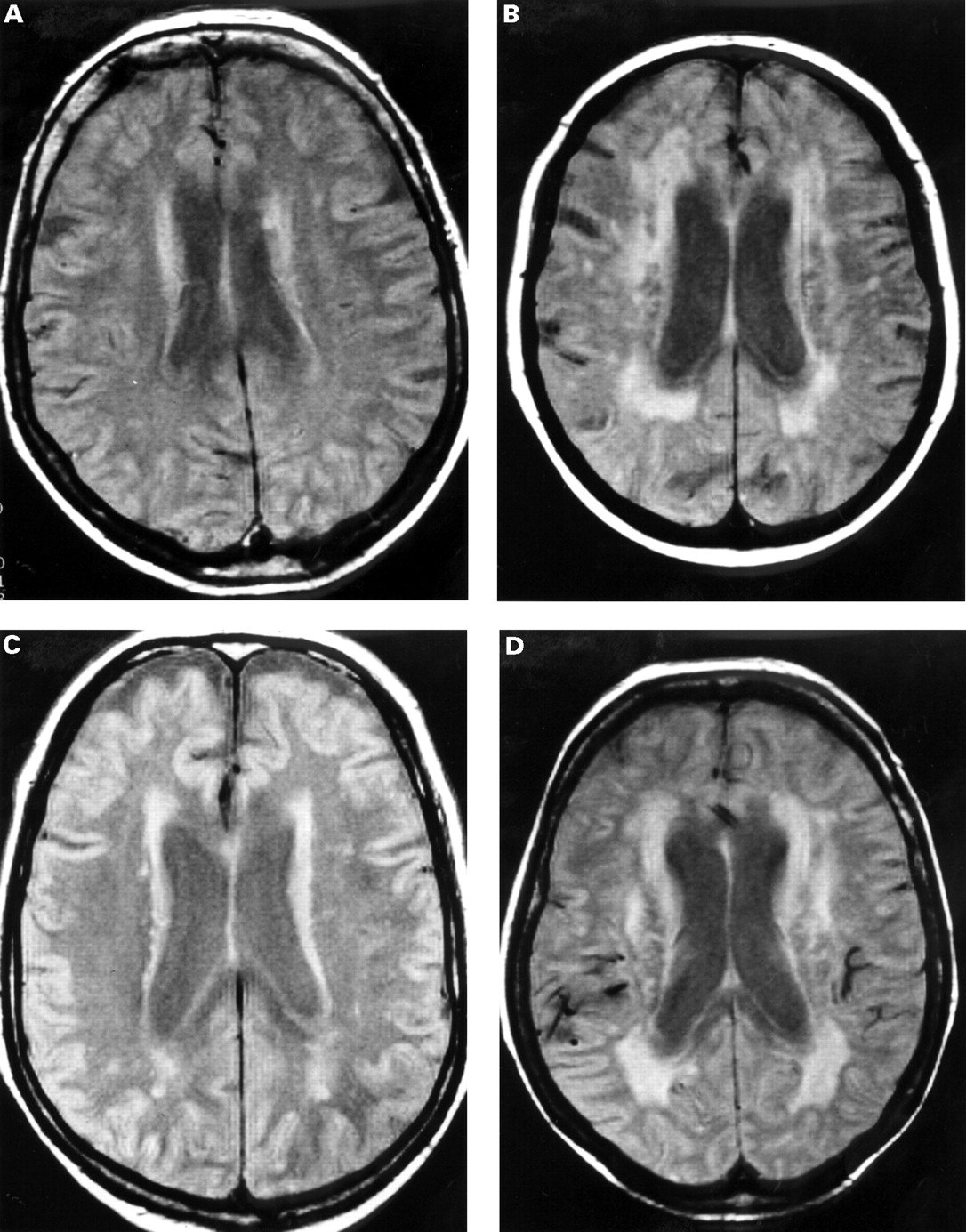 White matter lesions on magnetic resonance imaging in dementia with ...