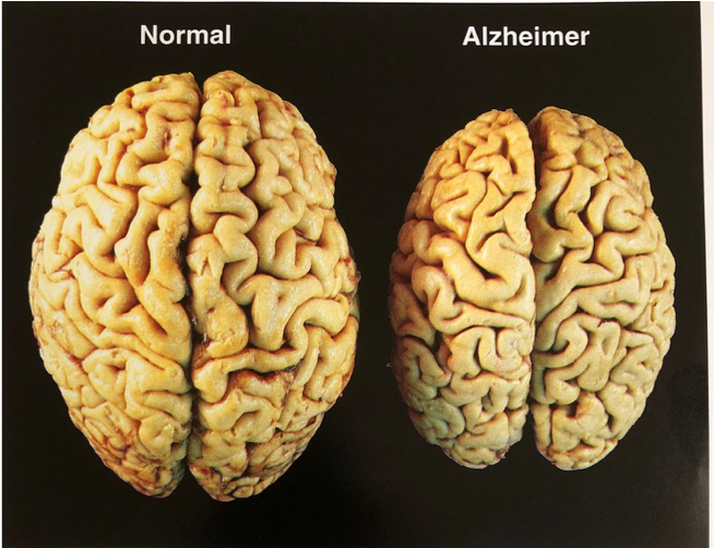 Why and How Alzheimers Progresses  Renee Harmon