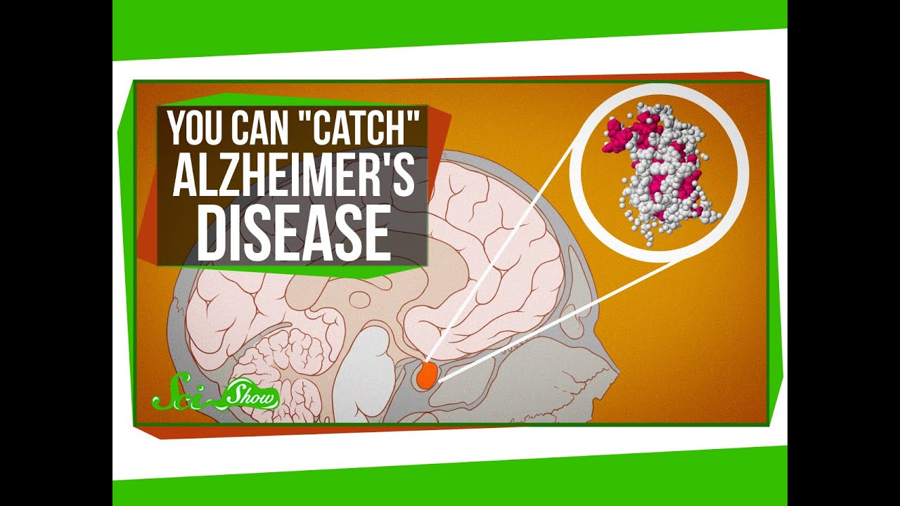 You Can " Catch"  Alzheimer